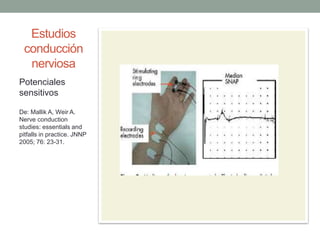 Estudios
conducción
nerviosa
Potenciales
sensitivos
De: Mallik A, Weir A.
Nerve conduction
studies: essentials and
pitfalls in practice. JNNP
2005; 76: 23-31.
 