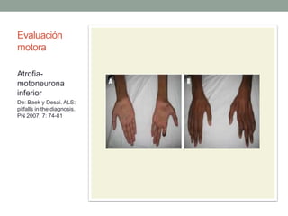 Evaluación
motora
Atrofia-
motoneurona
inferior
De: Baek y Desai. ALS:
pitfalls in the diagnosis.
PN 2007; 7: 74-81
 