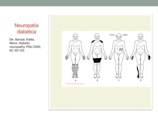 Neuropatía
diabética
De. Bansal, Kalita,
Misra. Diabetic
neuropathy. PMJ 2006;
82: 95-100.
 
