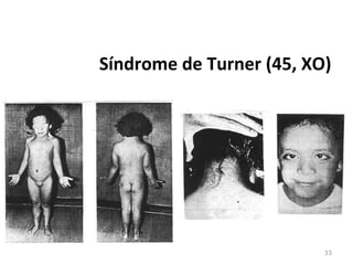 33
Síndrome de Turner (45, XO)
 