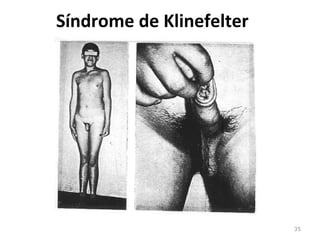 35
Síndrome de Klinefelter
 