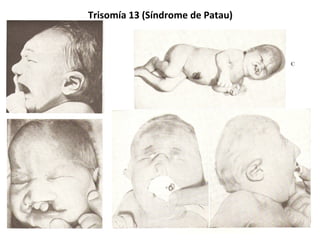 Trisomía 13 (Síndrome de Patau)
39
 