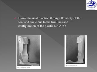  Biomechanical function through flexibilty of the
foot and ankle due to the trimlines and
configuration of the plastic NP-AFO
 