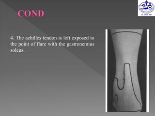 4. The achilles tendon is left exposed to
the point of flare with the gastronemius
soleus.
 