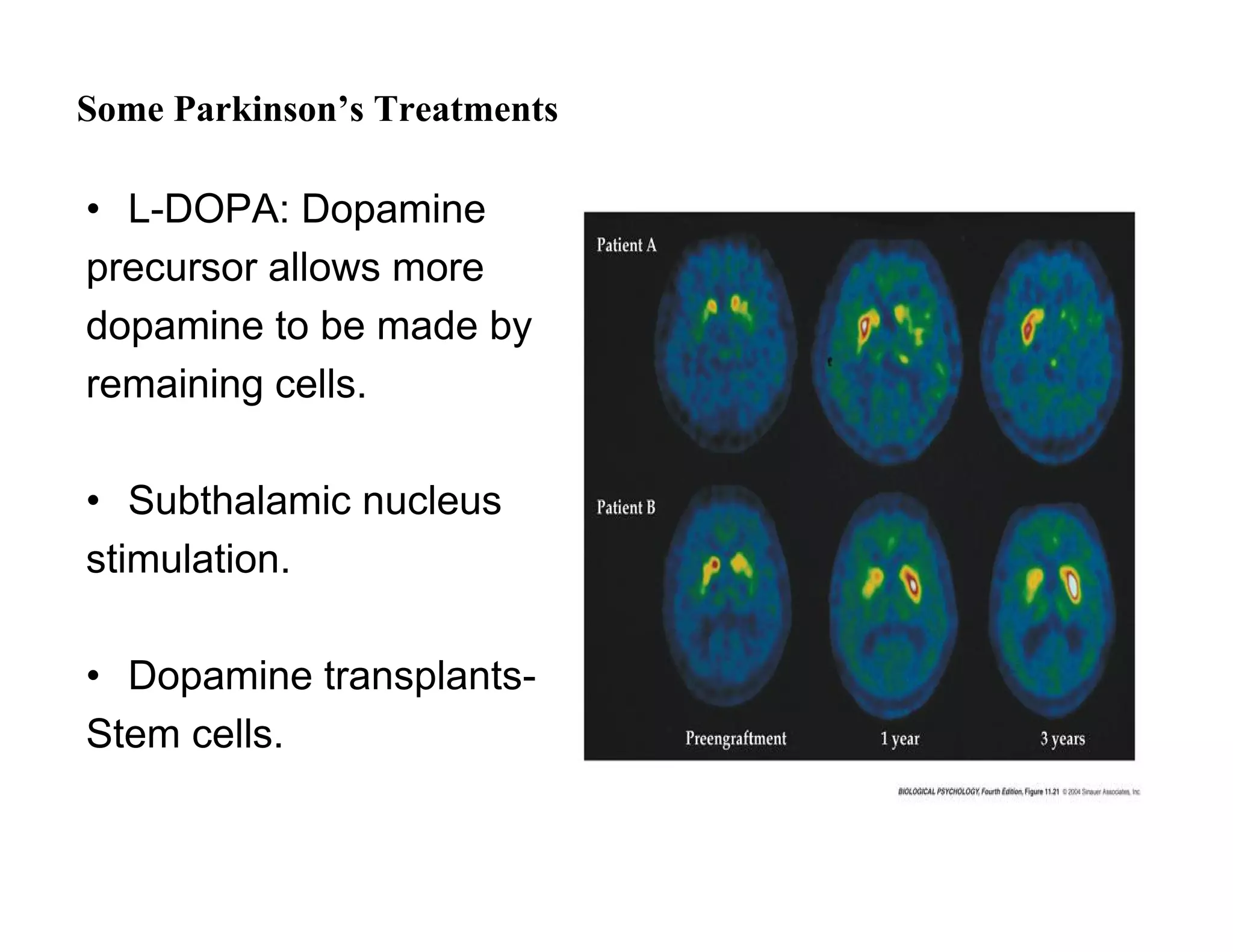 Some Parkinson’s Treatments

• L-DOPA: Dopamine
precursor allows more
dopamine to be made by
remaining cells.

• Subthalamic nucleus
stimulation.

• Dopamine transplants-
Stem cells.
 