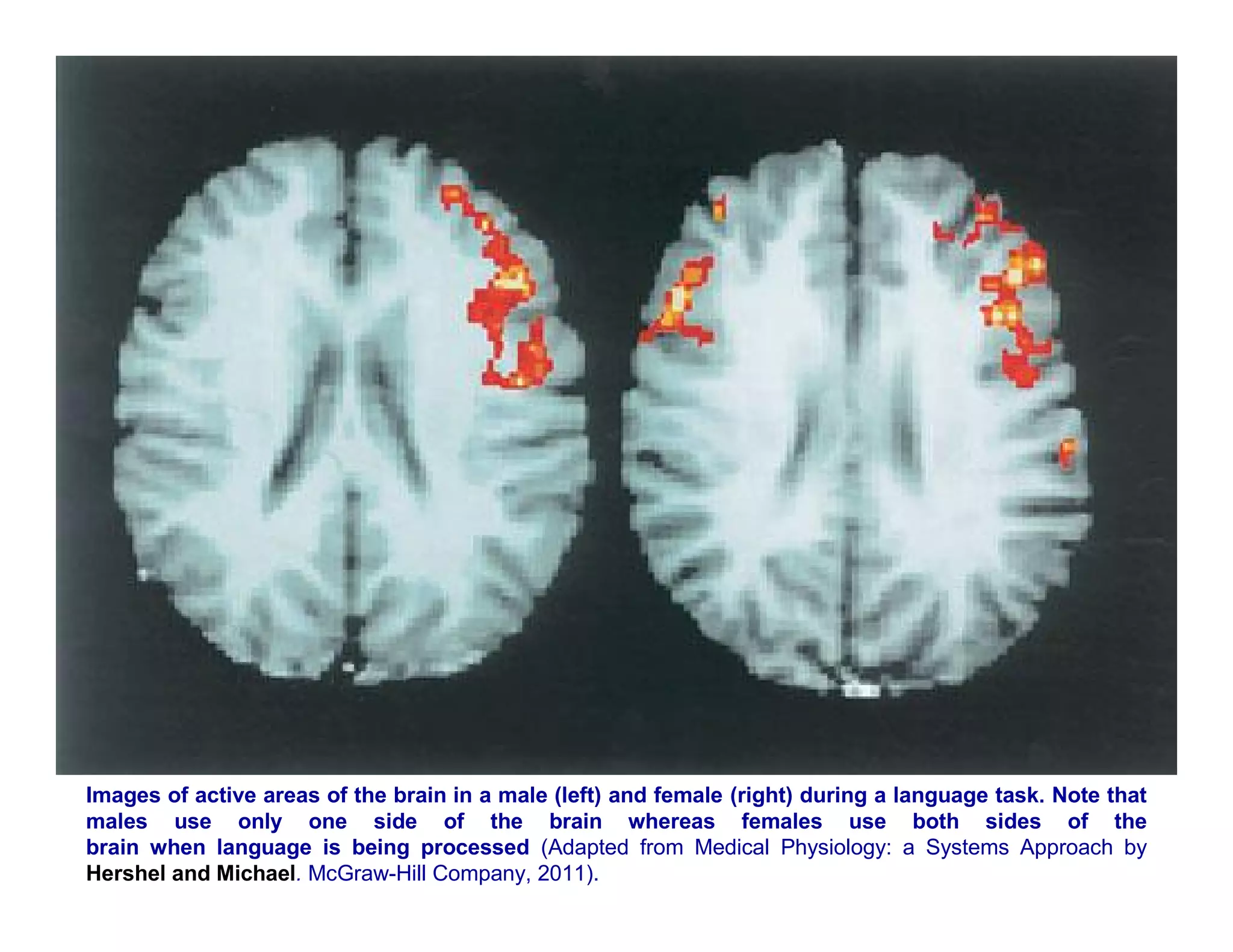 Images of active areas of the brain in a male (left) and female (right) during a language task. Note that
males use only one side of the brain whereas females use both sides of the
brain when language is being processed (Adapted from Medical Physiology: a Systems Approach by
Hershel and Michael. McGraw-Hill Company, 2011).
 