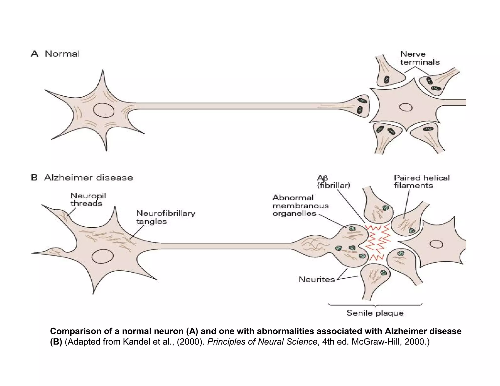Comparison of a normal neuron (A) and one with abnormalities associated with Alzheimer disease
(B) (Adapted from Kandel et al., (2000). Principles of Neural Science, 4th ed. McGraw-Hill, 2000.)
 