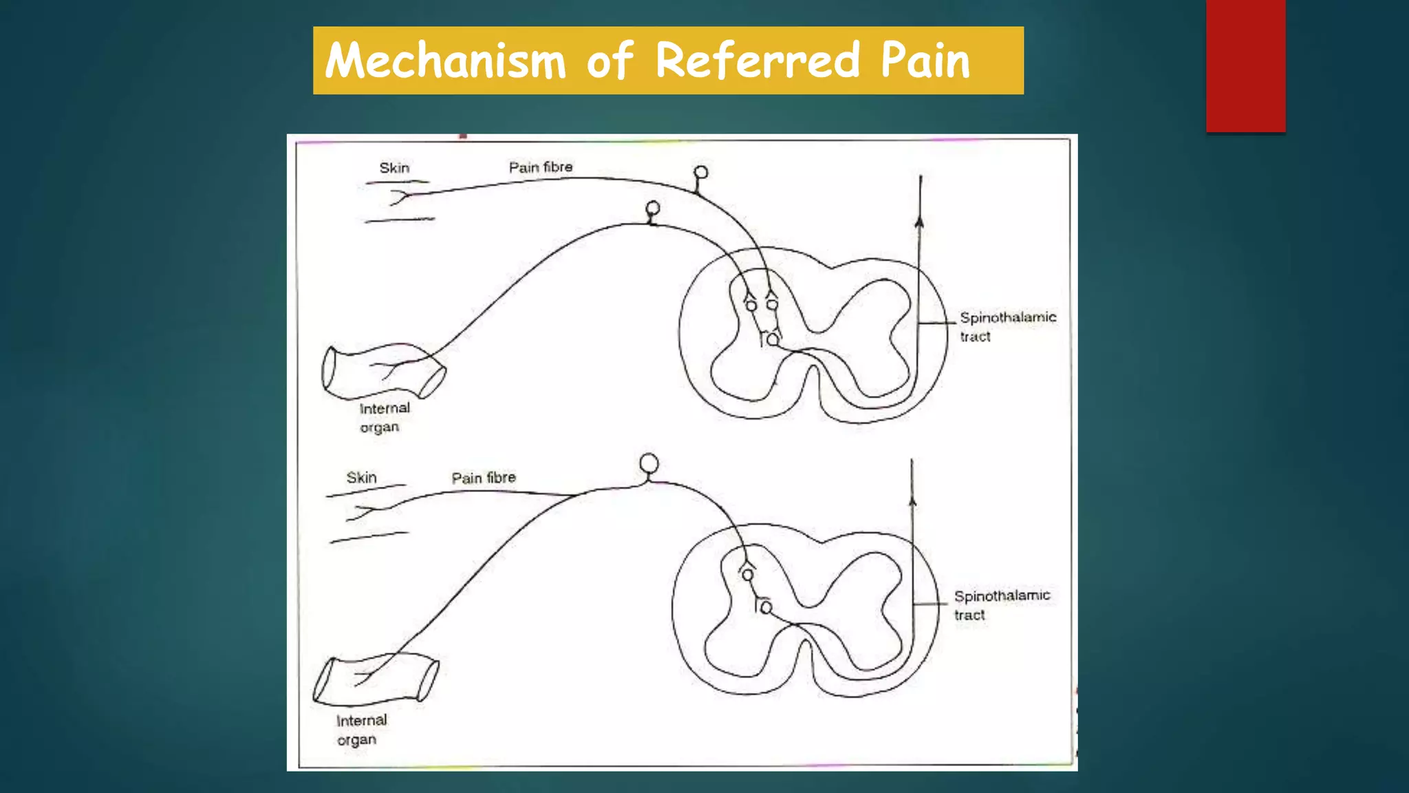 Referred Pain Explained Neurophysiology of pain | PPTX