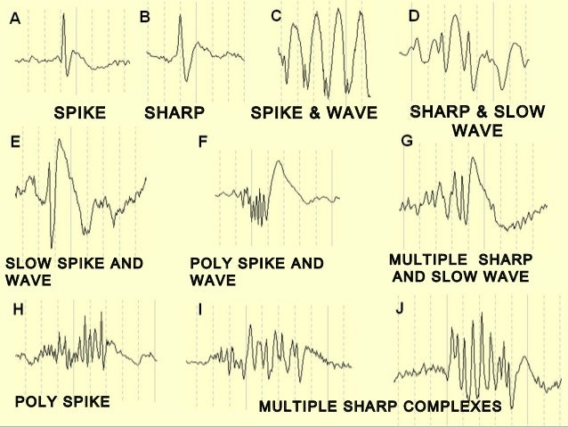 Neuro physiology of seizures & eeg, pedaitric neurologist ...