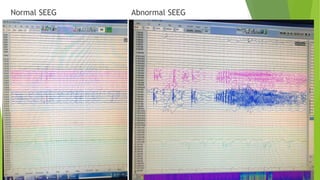 Normal SEEG Abnormal SEEG
 