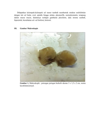 Didapatkan kelompok-kelompok sel tumor tumbuh membentuk struktur multilobular
dengan inti sel bulat, oval, spindle hingga stelate, pleomorfik, normokromatin, terapung
dalam massa mucin, diantaraya terdapat gambaran plexiform, dala stroma sembab,
hiperemik, bersebukan sel- sel limfosit, histiosit.
III. Gambar Makroskopis
Gambar 1. Makroskopik : potongan jaringan berkulit ukuran 3 x 1,5 x 2 cm, warna
kecoklatan,kenyal.
 