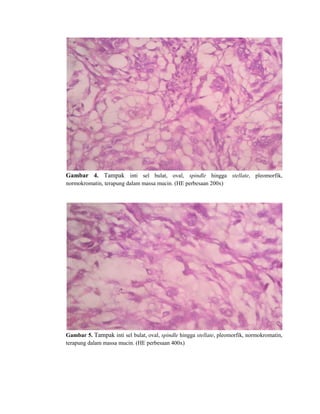 Gambar 4. Tampak inti sel bulat, oval, spindle hingga stellate, pleomorfik,
normokromatin, terapung dalam massa mucin. (HE perbesaan 200x)
Gambar 5. Tampak inti sel bulat, oval, spindle hingga stellate, pleomorfik, normokromatin,
terapung dalam massa mucin. (HE perbesaan 400x)
 