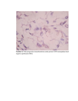 Gambar 6. Pada pengecatan imunohistokimia untuk protein S100 menunjukkan hasil
negative (perbesaran 400x)
 