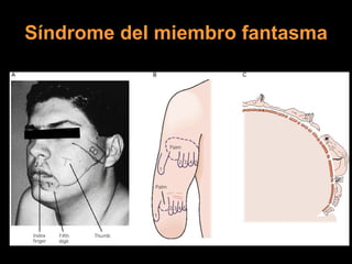 Síndrome del miembro fantasma 