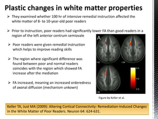 Plastic changes in white matter properties
 They examined whether 100 hr of intensive remedial instruction affected the
  white matter of 8- to 10-year-old poor readers

 Prior to instruction, poor readers had signiﬁcantly lower FA than good readers in a
  region of the left anterior centrum semiovale

 Poor readers were given remedial instruction
  which helps to improve reading skills

 The region where significant difference was
  found between poor and normal readers
  coincides with the region which showed FA
  increase after the mediation

 FA increased, meaning an increased orderedness
  of axonal diffusion (mechanism unkown)

                                                         Figure by Keller et al.

Keller TA, Just MA (2009): Altering Cortical Connectivity: Remediation-Induced Changes
in the White Matter of Poor Readers. Neuron 64: 624-631.
 