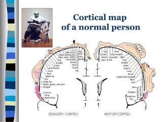 Cortical map
of a normal person
 