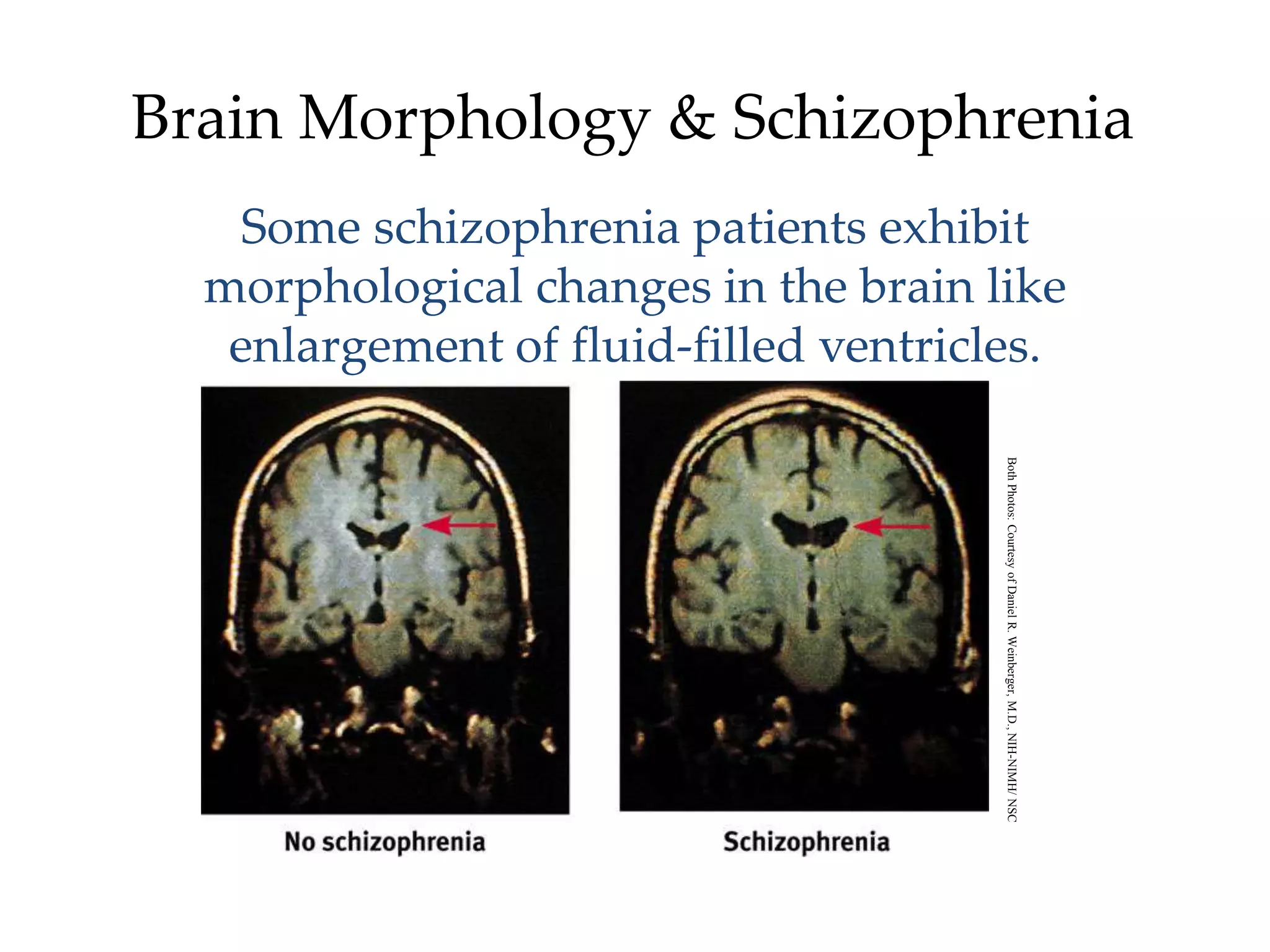 Brain Morphology & Schizophrenia
    Some schizophrenia patients exhibit
  morphological changes in the brain like
   enlargement of fluid-filled ventricles.




                                       Both Photos: Courtesy of Daniel R. Weinberger, M.D., NIH-NIMH/ NSC
 
