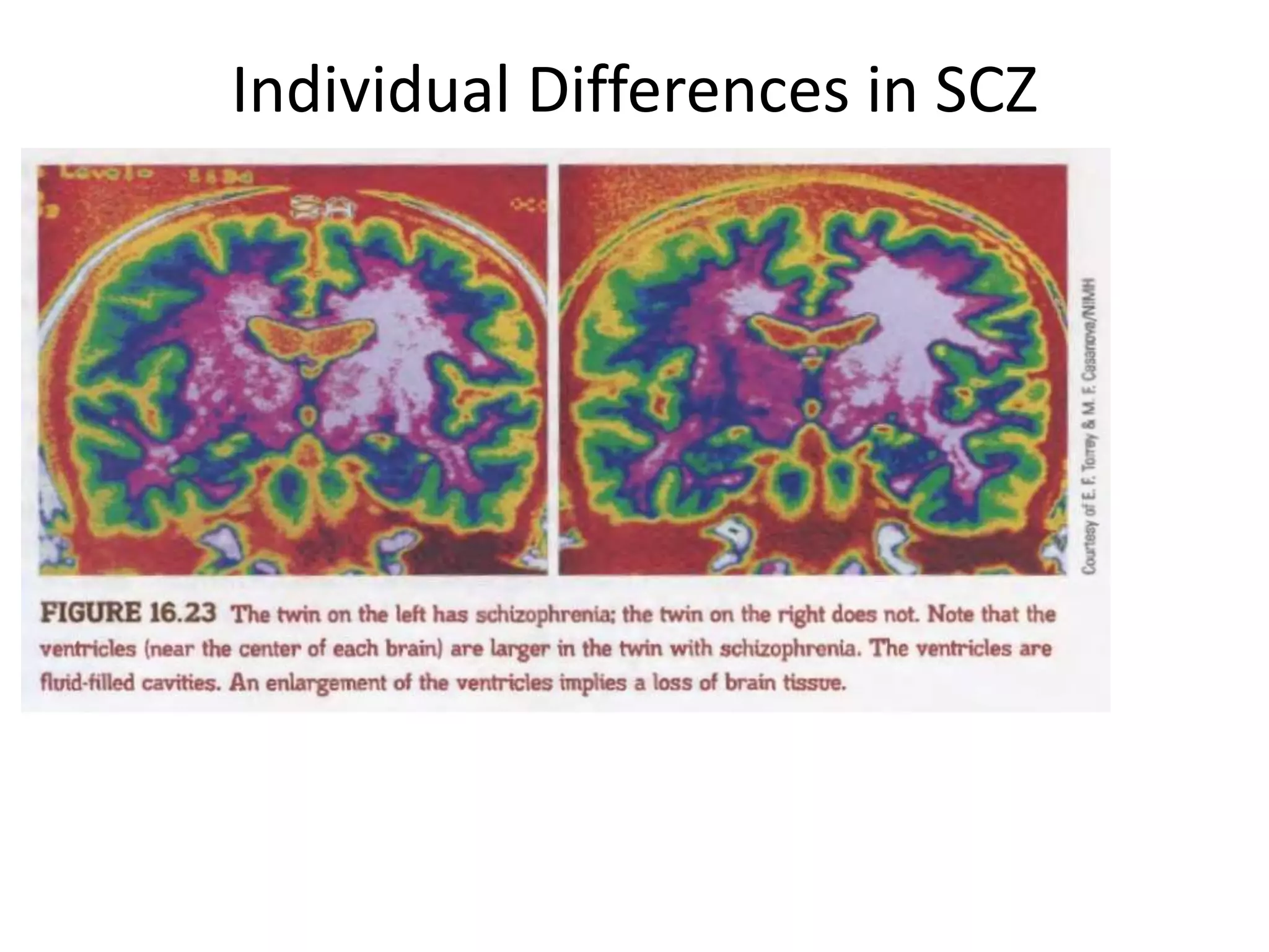 Individual Differences in SCZ
 