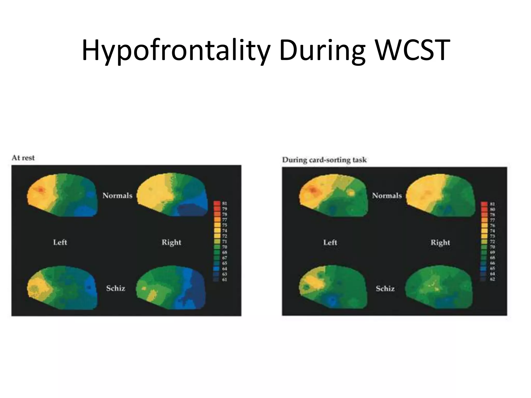 Hypofrontality During WCST
 