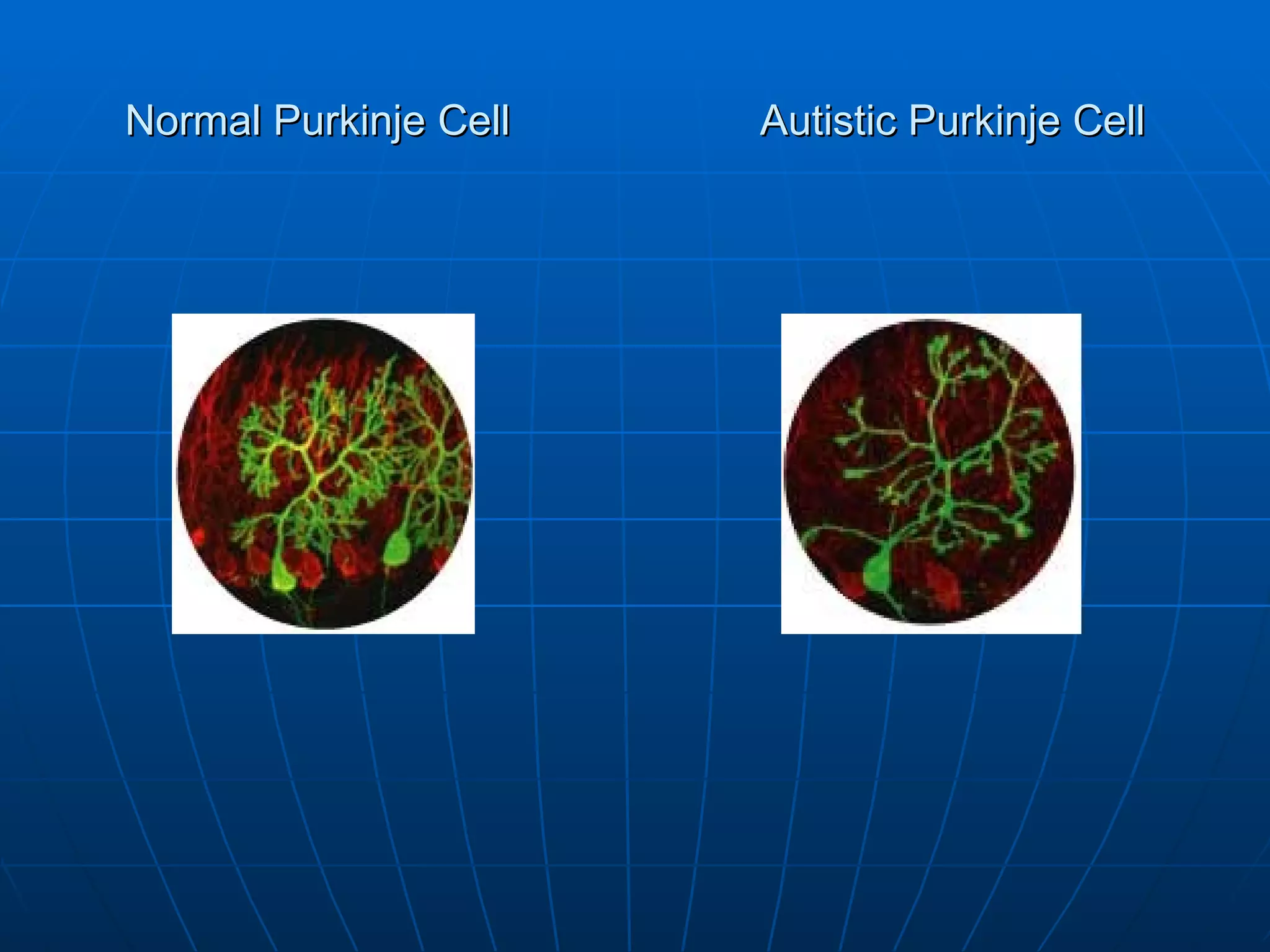Normal Purkinje Cell Autistic Purkinje Cell 