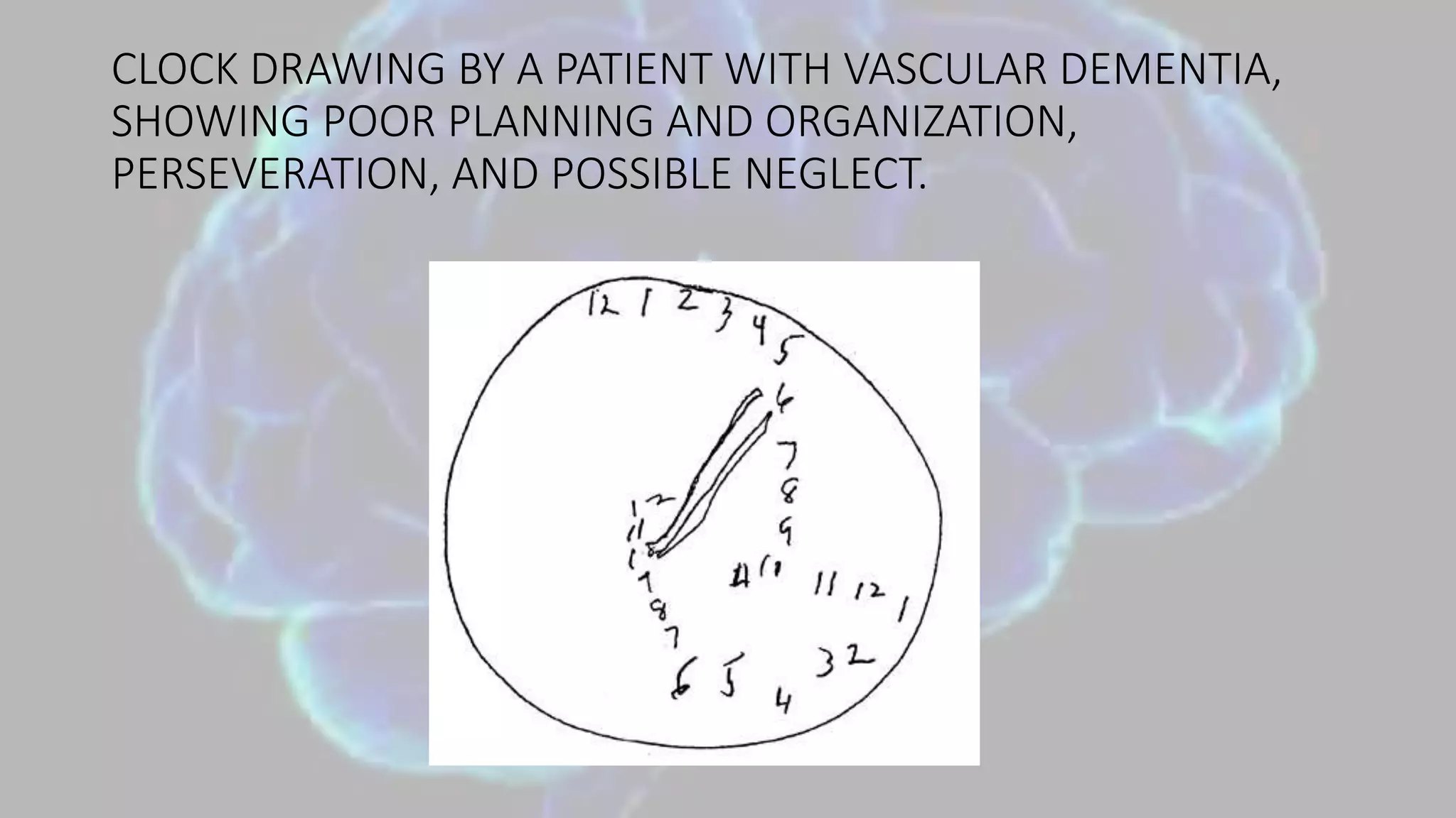 CLOCK DRAWING BY A PATIENT WITH VASCULAR DEMENTIA,
SHOWING POOR PLANNING AND ORGANIZATION,
PERSEVERATION, AND POSSIBLE NEGLECT.
 