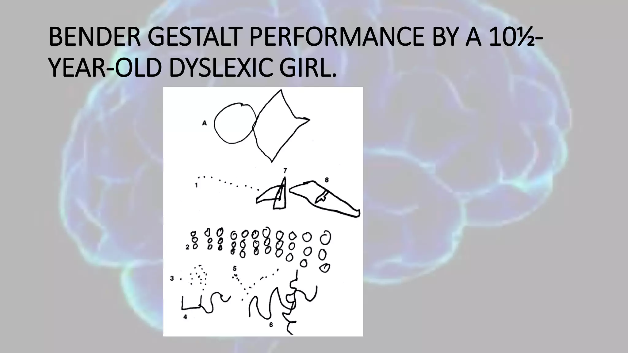 BENDER GESTALT PERFORMANCE BY A 10½-
YEAR-OLD DYSLEXIC GIRL.
 