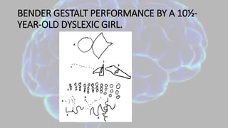 BENDER GESTALT PERFORMANCE BY A 10½-
YEAR-OLD DYSLEXIC GIRL.
 
