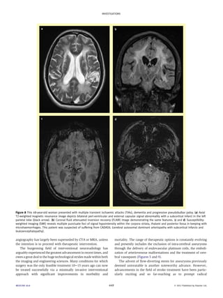Figure 8 This 48-year-old woman presented with multiple transient ischaemic attacks (TIAs), dementia and progressive pseudobulbar palsy. (a) Axial 
T2-weighted magnetic resonance image depicts bilateral peri-ventricular and external capsular signal abnormality with a subcortical infarct in the left 
parietal lobe (black arrow). (b) Coronal fluid attenuated inversion recovery (FLAIR) image demonstrating the same features. (c and d) Susceptibility-weighted 
imaging (SWI) reveals multiple punctuate foci of signal hypointensity within the corpora striata, thalami and posterior fossa in keeping with 
microhaemorrhages. This patient was suspected of suffering from CADASIL (cerebral autosomal dominant arteriopathy with subcortical infarcts and 
leukoencephalopathy). 
angiography has largely been superseded by CTA or MRA, unless 
the intention is to proceed with therapeutic intervention. 
The burgeoning field of interventional neuroradiology has 
arguably experienced the greatest advancement in recent times, and 
owes a great deal to the huge technological stridesmade within both 
the imaging and engineering sciences. Many conditions for which 
surgery was the only feasible treatment 10e15 years ago can now 
be treated successfully via a minimally invasive interventional 
approach with significant improvements in morbidity and 
mortality. The range of therapeutic options is constantly evolving 
and presently includes the exclusion of intra-cerebral aneurysms 
through the delivery of endovascular platinum coils, the emboli-zation 
of arteriovenous malformations and the treatment of cere-bral 
vasospasm (Figures 5 and 9). 
The advent of flow-diverting stents for aneurysms previously 
deemed untreatable is another noteworthy advance. However, 
advancements in the field of stroke treatment have been partic-ularly 
exciting and so far-reaching as to prompt radical 
INVESTIGATIONS 
MEDICINE 40:8 449  2012 Published by Elsevier Ltd. 
 