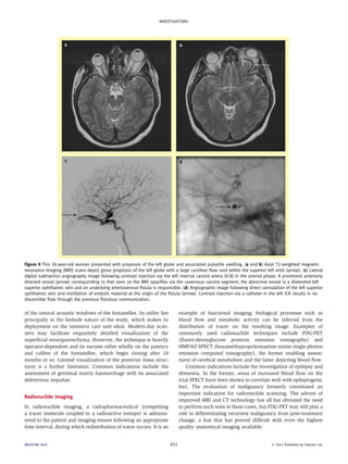 INVESTIGATIONS 
Figure 9 This 26-year-old woman presented with proptosis of the left globe and associated pulsatile swelling. (a and b) Axial T2-weighted magnetic 
resonance imaging (MRI) scans depict gross proptosis of the left globe with a large curvilear flow void within the superior left orbit (arrow). (c) Lateral 
digital subtraction angiography image following contrast injection via the left internal carotid artery (ICA) in the arterial phase. A prominent anteriorly 
directed vessel (arrow) corresponding to that seen on the MRI opacifies via the cavernous carotid segment; the abnormal vessel is a distended left 
superior ophthalmic vein and an underlying arteriovenous fistula is responsible. (d) Angiographic image following direct cannulation of the left superior 
ophthalmic vein and instillation of embolic material at the origin of the fistula (arrow). Contrast injection via a catheter in the left ICA results in no 
discernible flow through the previous fistulous communication. 
of the natural acoustic windows of the fontanelles. Its utility lies 
principally in the bedside nature of the study, which makes its 
deployment on the intensive care unit ideal. Modern-day scan-ners 
may facilitate exquisitely detailed visualization of the 
superficial neuroparenchyma. However, the technique is heavily 
operator-dependent and its success relies wholly on the patency 
and calibre of the fontanelles, which begin closing after 10 
months or so. Limited visualization of the posterior fossa struc-tures 
is a further limitation. Common indications include the 
assessment of germinal matrix haemorrhage with its associated 
deleterious sequelae. 
Radionuclide imaging 
In radionuclide imaging, a radiopharmaceutical (comprising 
a tracer molecule coupled to a radioactive isotope) is adminis-tered 
to the patient and imaging ensues following an appropriate 
time interval, during which redistribution of tracer occurs. It is an 
example of functional imaging; biological processes such as 
blood flow and metabolic activity can be inferred from the 
distribution of tracer on the resulting image. Examples of 
commonly used radionuclide techniques include FDG-PET 
(fluoro-deoxyglucose positron emission tomography) and 
HMPAO SPECT (hexamethypropyleneamine oxime single photon 
emission computed tomography), the former enabling assess-ment 
of cerebral metabolism and the latter depicting blood flow. 
Common indications include the investigation of epilepsy and 
dementia. In the former, areas of increased blood flow on the 
ictal SPECT have been shown to correlate well with epileptogenic 
foci. The evaluation of malignancy formerly constituted an 
important indication for radionuclide scanning. The advent of 
improved MRI and CT technology has all but obviated the need 
to perform such tests in these cases, but FDG-PET may still play a 
role in differentiating recurrent malignancy from post-treatment 
change, a feat that has proved difficult with even the highest 
quality anatomical imaging available. 
MEDICINE 40:8 451  2012 Published by Elsevier Ltd. 
 