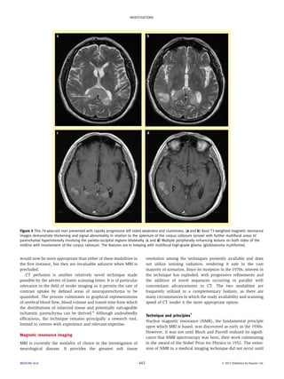 Figure 3 This 74-year-old man presented with rapidly progressive left sided weakness and clumsiness. (a and b) Axial T2-weighted magnetic resonance 
images demonstrate thickening and signal abnormality in relation to the splenium of the corpus callosum (arrow) with further multifocal areas of 
parenchymal hyperintensity involving the parieto-occipital regions bilaterally. (c and d) Multiple peripherally enhancing lesions on both sides of the 
midline with involvement of the corpus callosum. The features are in keeping with multifocal high-grade glioma (glioblastoma multiforme). 
would now be more appropriate than either of these modalities in 
the first instance, but they are invaluable adjuncts when MRI is 
precluded. 
CT perfusion is another relatively novel technique made 
possible by the advent of faster scanning times. It is of particular 
relevance in the field of stroke imaging as it permits the rate of 
contrast uptake by defined areas of neuroparenchyma to be 
quantified. The process culminates in graphical representations 
of cerebral blood flow, blood volume and transit time from which 
the distributions of infarcted tissue and potentially salvageable 
ischaemic parenchyma can be derived.6 Although undoubtedly 
efficacious, the technique remains principally a research tool, 
limited to centres with experience and relevant expertise. 
Magnetic resonance imaging 
MRI is currently the modality of choice in the investigation of 
neurological disease. It provides the greatest soft tissue 
resolution among the techniques presently available and does 
not utilize ionizing radiation, rendering it safe in the vast 
majority of scenarios. Since its inception in the 1970s, interest in 
the technique has exploded, with progressive refinements and 
the addition of novel sequences occurring in parallel with 
concomitant advancements in CT. The two modalities are 
frequently utilized in a complementary fashion, as there are 
many circumstances in which the ready availability and scanning 
speed of CT render it the more appropriate option. 
Technique and principles7 
Nuclear magnetic resonance (NMR), the fundamental principle 
upon which MRI is based, was discovered as early as the 1930s. 
However, it was not until Bloch and Purcell realized its signifi-cance 
that NMR spectroscopy was born, their work culminating 
in the award of the Nobel Prize for Physics in 1952. The exten-sion 
of NMR to a medical imaging technique did not occur until 
INVESTIGATIONS 
MEDICINE 40:8 443  2012 Published by Elsevier Ltd. 
 