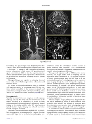 INVESTIGATIONS 
Figure 4 (continued) 
haemorrhage also appears bright due to the paramagnetic char-acteristics 
of iron within methaemoglobin, giving rise to so-called 
‘T1-shortening’. T1 images are also employed to demonstrate 
contrast enhancement, which occurs with gadolinium-based 
agents whose intrinsic ability to alter the magnetic properties 
of blood is responsible for signal augmentation. The indications 
for performing contrast-enhanced studies are analogous to those 
in CT imaging. 
T2-weighted images are superior in delineating abnormal 
tissues such as those harbouring infection, inflammation and 
neoplastic disease. 
T2* images are optimized to assess the effects of molecules 
with magnetic properties on surrounding tissues. The iron con-tained 
within haemoglobin is the commonest example and 
demonstrates paramagnetic effects following haemorrhage, which 
alter the local magnetic field within its vicinity (Figures 4 and 6). 
Scanning protocols 
Typically, a routine brain scan comprises several sequences 
including not only the above but also those tailored to the 
specific indication. It is conventional to include all three 
orthogonal planes (axial, coronal, sagittal), although any plane of 
imaging is theoretically possible, unlike CT. Spinal scanning 
typically includes sagittal imaging and selected axial slices 
through any regions of interest. 
There are a number of additional sequences that are particu-larly 
advantageous in certain scenarios. For example, those that 
suppress CSF-signal can be invaluable in visualizing the peri-ventricular 
lesions that characterize multiple sclerosis by 
greatly improving their conspicuity. FLAIR (fluid-attenuated 
inversion recovery) is such a sequence that has also proved to be 
valuable in monitoring tumour follow-up. 
Fat-suppressed sequences such as STIR (short-tau inverse 
recovery) are images created with T2-weighting but with 
suppression of signal generated by fat. This improves conspicuity 
of entities such as oedema, where the high signal of fat may 
obscure the boundaries of a pathological process. Fat-suppressed 
axial imaging through the neck is frequently employed in 
vascular dissection protocols, where the perceptibility of intra-mural 
haematoma is improved. High spatial resolution tech-niques 
such as CISS (constructive interference in steady state) 
provide exquisitely detailed images of inner ear anatomy and the 
lower cranial nerves, facilitating detection of even small 
cerebello-pontine angle lesions, for example, without the use of 
intravenous contrast. Establishing evidence of vascular contact 
in suspected cases of trigeminal neuralgia or hemi-facial spasm 
are further applications. 
Diffusion-weighted imaging (DWI) utilizes the principle that 
the signals generated by protons in water molecules differ 
depending upon whether free diffusion is occurring; when 
Brownian motion is not permitted due to pathological processes, 
a differential MR signal is generated, which may be ‘mapped’. 
In normal tissues or those in which vasogenic oedema occurs, 
random Brownian motion of water molecules is not limited and 
thus no diffusion restriction is seen. In tissues with a tight degree 
of cellular packing or those in which cytotoxic oedema occurs, 
MEDICINE 40:8 445  2012 Published by Elsevier Ltd. 
 