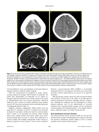 INVESTIGATIONS 
Figure 5 This 28-year-old woman presented with a history of headaches followed by progressive cerebral obtundation. There was a preceding history of 
non-Hodgkin’s lymphoma. (a) Axial CT venogram (CTV) image at the vertex demonstrates irregular filling defects within the superior sagittal sinus 
(arrows) with segments of non-opacification of the visualized cortical veins. The features are highly suggestive of sagittal sinus and cortical vein 
thrombosis. (b) More inferiorly, a discrete filling defect is visible within the superior sagittal sinus e the ‘empty delta sign’ (black arrow). The superior 
sagittal sinus is also expanded and hyperdense, suggestive of acute thrombosis. Scattered foci of para-sagittal parenchymal haemorrhage are also visible 
(white arrows). (c) CTV midline sagittal maximum intensity projection image further demonstrates multiple filling defects within the superior sagittal sinus 
(arrow). (d) Antero-posterior digital subtraction angiography (DSA) image depicting filling defects within the right transverse sinus and superior sagittal 
sinus (arrows). A catheter has been placed within the right transverse sinus during attempted mechanical thrombectomy. 
restricted diffusion occurs and manifests as decreased signal on 
apparent diffusion coefficient (ADC) mapping. 
DWI has revolutionized the diagnosis of stroke, demon-strating 
unequivocal changes within minutes of infarction, far 
earlier than abnormalities are detectable on CT (Figure 4). 
Changes classically persist for up to 3 weeks, which can be useful 
in distinguishing acute from chronic phenomena. Restricted 
diffusion is also a feature of cerebral abscesses, prion diseases 
such as CJD8 and certain neoplastic lesions including lymphomas 
and high-grade gliomas (Figure 7). 
Magnetic resonance angiography (MRA) differs from the 
equivalent CT technique in that it is possible non-invasively 
to depict the vasculature without the need for contrast media. 
This is based on the principle that protons within flowing 
blood return signals distinct from those within static tissue. 
Post-processing steps are able to extract these differences to 
create so-called ‘time-of-flight’ angiographic images (Figure 4). 
Selective depiction of the arterial or venous tree is possible. 
However, contrast-enhanced MRA (CEMRA) is increasingly 
being performed for the diagnosis and follow-up of aneurysms 
and other vascular malformations on account of its improved 
resolution. 
MR spectroscopy remains mostly the remit of research despite 
early promise. Its basis lies in the ability of the MR signal to 
provide quantitative information regarding chemical composi-tion. 
Although the technique may be advantageous in certain 
defined situations, such as the differentiation of recurrent 
neoplasm from treatment-related change, and the assessment 
and monitoring of the leukodystrophies,9 it has largely failed to 
make a significant impact on routine clinical practice. 
Novel developments and future directions 
The intense research activity focused on MRI over the last four 
decades shows no signs of diminishing with numerous advances 
and technical refinements steadily adding to what is already 
available in the world of clinical practice. 
MEDICINE 40:8 446  2012 Published by Elsevier Ltd. 
 