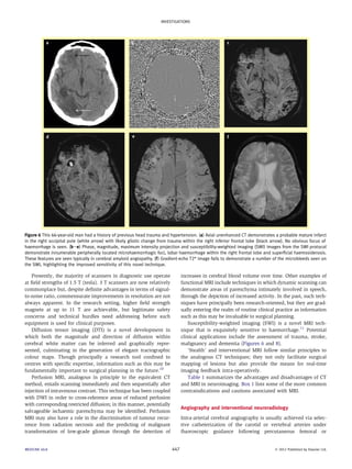 INVESTIGATIONS 
Figure 6 This 66-year-old man had a history of previous head trauma and hypertension. (a) Axial unenhanced CT demonstrates a probable mature infarct 
in the right occipital pole (white arrow) with likely gliotic change from trauma within the right inferior frontal lobe (black arrow). No obvious focus of 
haemorrhage is seen. (bee) Phase, magnitude, maximum intensity projection and susceptibility-weighted imaging (SWI) images from the SWI protocol 
demonstrate innumerable peripherally located microhaemorrhagic foci, lobar haemorrhage within the right frontal lobe and superficial haemosiderosis. 
These features are seen typically in cerebral amyloid angiopathy. (f ) Gradient-echo T2* image fails to demonstrate a number of the microbleeds seen on 
the SWI, highlighting the improved sensitivity of this novel technique. 
Presently, the majority of scanners in diagnostic use operate 
at field strengths of 1.5 T (tesla). 3 T scanners are now relatively 
commonplace but, despite definite advantages in terms of signal-to- 
noise ratio, commensurate improvements in resolution are not 
always apparent. In the research setting, higher field strength 
magnets at up to 11 T are achievable, but legitimate safety 
concerns and technical hurdles need addressing before such 
equipment is used for clinical purposes. 
Diffusion tensor imaging (DTI) is a novel development in 
which both the magnitude and direction of diffusion within 
cerebral white matter can be inferred and graphically repre-sented, 
culminating in the generation of elegant tractographic 
colour maps. Though principally a research tool confined to 
centres with specific expertise, information such as this may be 
fundamentally important to surgical planning in the future.10 
Perfusion MRI, analogous in principle to the equivalent CT 
method, entails scanning immediately and then sequentially after 
injection of intravenous contrast. This technique has been coupled 
with DWI in order to cross-reference areas of reduced perfusion 
with corresponding restricted diffusion; in this manner, potentially 
salvageable ischaemic parenchyma may be identified. Perfusion 
MRI may also have a role in the discrimination of tumour recur-rence 
from radiation necrosis and the predicting of malignant 
transformation of low-grade gliomas through the detection of 
increases in cerebral blood volume over time. Other examples of 
functional MRI include techniques in which dynamic scanning can 
demonstrate areas of parenchyma intimately involved in speech, 
through the depiction of increased activity. In the past, such tech-niques 
have principally been research-oriented, but they are grad-ually 
entering the realm of routine clinical practice as information 
such as this may be invaluable to surgical planning. 
Susceptibility-weighted imaging (SWI) is a novel MRI tech-nique 
that is exquisitely sensitive to haemorrhage.11 Potential 
clinical applications include the assessment of trauma, stroke, 
malignancy and dementia (Figures 6 and 8). 
‘Stealth’ and interventional MRI follow similar principles to 
the analogous CT techniques; they not only facilitate surgical 
mapping of lesions but also provide the means for real-time 
imaging feedback intra-operatively. 
Table 1 summarizes the advantages and disadvantages of CT 
and MRI in neuroimaging. Box 1 lists some of the more common 
contraindications and cautions associated with MRI. 
Angiography and interventional neuroradiology 
Intra-arterial cerebral angiography is usually achieved via selec-tive 
catheterization of the carotid or vertebral arteries under 
fluoroscopic guidance following percutaneous femoral or 
MEDICINE 40:8 447  2012 Published by Elsevier Ltd. 
 