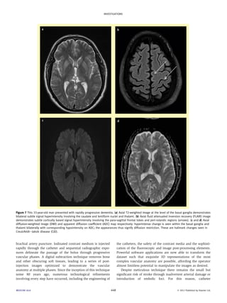 INVESTIGATIONS 
Figure 7 This 33-year-old man presented with rapidly progressive dementia. (a) Axial T2-weighted image at the level of the basal ganglia demonstrates 
bilateral subtle signal hyperintensity involving the caudate and lentiform nuclei and thalami. (b) Axial fluid attenuated inversion recovery (FLAIR) image 
demonstrates subtle cortically based signal hyperintensity involving the para-sagittal frontal lobes and peri-rolandic regions (arrows). (c and d) Axial 
diffusion-weighted image (DWI) and apparent diffusion coefficient (ADC) map respectively: hyperintense change is seen within the basal ganglia and 
thalami bilaterally with corresponding hypointensity on ADC; the appearances thus signify diffusion restriction. These are hallmark changes seen in 
CreutzfeldteJakob disease (CJD). 
brachial artery puncture. Iodinated contrast medium is injected 
rapidly through the catheter and sequential radiographic expo-sures 
delineate the passage of the bolus through progressive 
vascular phases. A digital subtraction technique removes bone 
and other obscuring soft tissues, leading to a series of post-injection 
images optimized to demonstrate the vascular 
anatomy at multiple phases. Since the inception of this technique 
some 80 years ago, numerous technological refinements 
involving every step have occurred, including the engineering of 
the catheters, the safety of the contrast media and the sophisti-cation 
of the fluoroscopic and image post-processing elements. 
Powerful software applications are now able to transform the 
dataset such that exquisite 3D representations of the most 
complex vascular anatomy are possible, affording the operator 
almost limitless potential to manipulate the images as desired. 
Despite meticulous technique there remains the small but 
significant risk of stroke through inadvertent arterial damage or 
introduction of embolic foci. For this reason, catheter 
MEDICINE 40:8 448  2012 Published by Elsevier Ltd. 
 