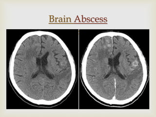 Neuro radiology neuroimaging | PPTX