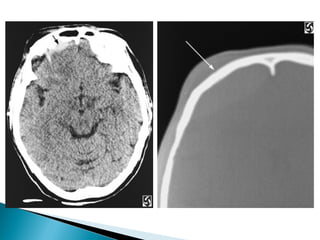 Neuroradiology head trauma | PPT