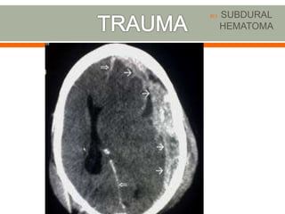 Neuroradiology slideshare Slide 11
