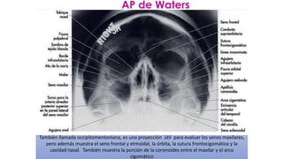 También llamada occipitomentoniana, es una proyección útil para evaluar los senos maxilares,
pero además muestra el seno frontal y etmoidal, la órbita, la sutura frontocigomática y la
cavidad nasal. También muestra la porción de la coronoides entre el maxilar y el arco
cigomático
AP de Waters
 