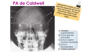 PA de Caldwell
A. Margen
supraorbitario
B. Crista gali del
etmoides
C. Sutura sagital
(cráneo posterior)
D. Sutura
lambdoidea
E. Cresta petrosa
 