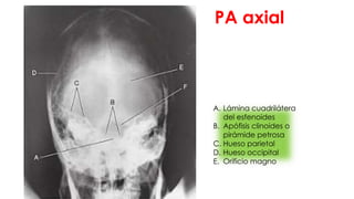 PA axial
A. Lámina cuadrilátera
del esfenoides
B. Apófisis clinoides o
pirámide petrosa
C. Hueso parietal
D. Hueso occipital
E. Orificio magno
 