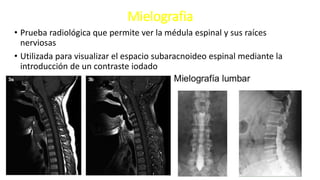 Mielografia
• Prueba radiológica que permite ver la médula espinal y sus raíces
nerviosas
• Utilizada para visualizar el espacio subaracnoideo espinal mediante la
introducción de un contraste iodado
 