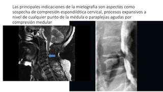 Las principales indicaciones de la mielografía son aspectos como
sospecha de compresión espondilótica cervical, procesos expansivos a
nivel de cualquier punto de la médula o paraplejias agudas por
compresión medular
 