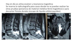 Hoy en día se utiliza escáner y resonancia magnética
Se reserva la radiculografía para casos donde no se puedan realizar las
otras pruebas (presencia de material metálico ferró magnético) o para
descartar fístulas durales (escape de líquido cefalorraquídeo)
 