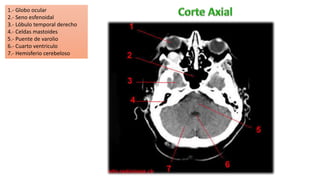 1.- Globo ocular
2.- Seno esfenoidal
3.- Lóbulo temporal derecho
4.- Celdas mastoides
5.- Puente de varolio
6.- Cuarto ventriculo
7.- Hemisferio cerebeloso
 