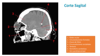 1.- Globo ocular
2.- Circunvoluciones frontales
3.- Cisura de Silvio
4.- Circunvoluciones occipitales
5.- Tentorio
6.- Hemisferio cerebeloso
7.- Giro parahipocampal
 