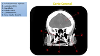 1.- Circunvoluciones frontales
2.- Arco cigomático
3.- Mandíbula
4.- Cornete nasal
5.- Arcada alveolar
6.- Seno maxilar derecho
 