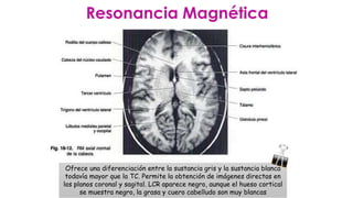 Resonancia Magnética
Ofrece una diferenciación entre la sustancia gris y la sustancia blanca
todavía mayor que la TC. Permite la obtención de imágenes directas en
los planos coronal y sagital. LCR aparece negro, aunque el hueso cortical
se muestra negro, la grasa y cuero cabelludo son muy blancas
 