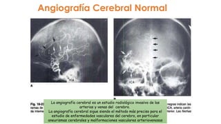Angiografía Cerebral Normal
La angiografía cerebral es un estudio radiológico invasivo de las
arterias y venas del cerebro.
La angiografía cerebral sigue siendo el método más preciso para el
estudio de enfermedades vasculares del cerebro, en particular
aneurismas cerebrales y malformaciones vasculares arteriovenosas
 