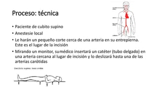 Proceso: técnica
• Paciente de cubito supino
• Anestesie local
• Le harán un pequeño corte cerca de una arteria en su entrepierna.
Este es el lugar de la incisión
• Mirando un monitor, sumédico insertará un catéter (tubo delgado) en
una arteria cercana al lugar de incisión y lo deslizará hasta una de las
arterias carótidas
 