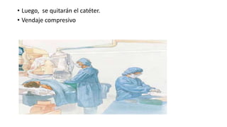 • Luego, se quitarán el catéter.
• Vendaje compresivo
 